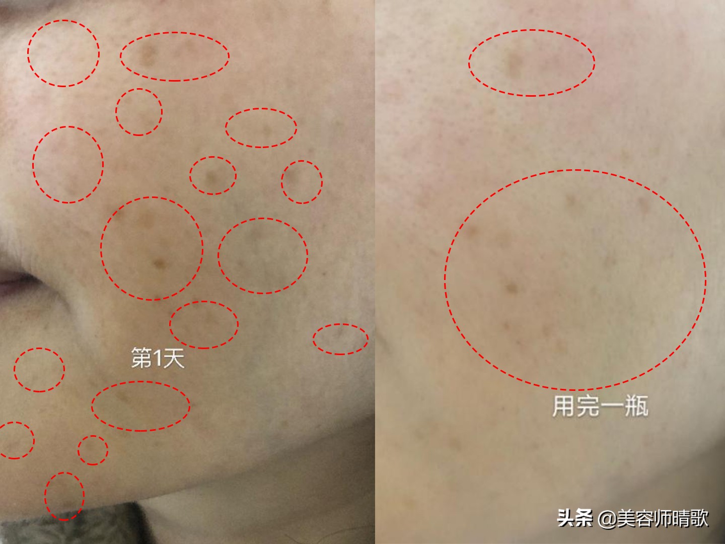 淡斑小白瓶精华二代,小白瓶淡斑精华光感和水感区别