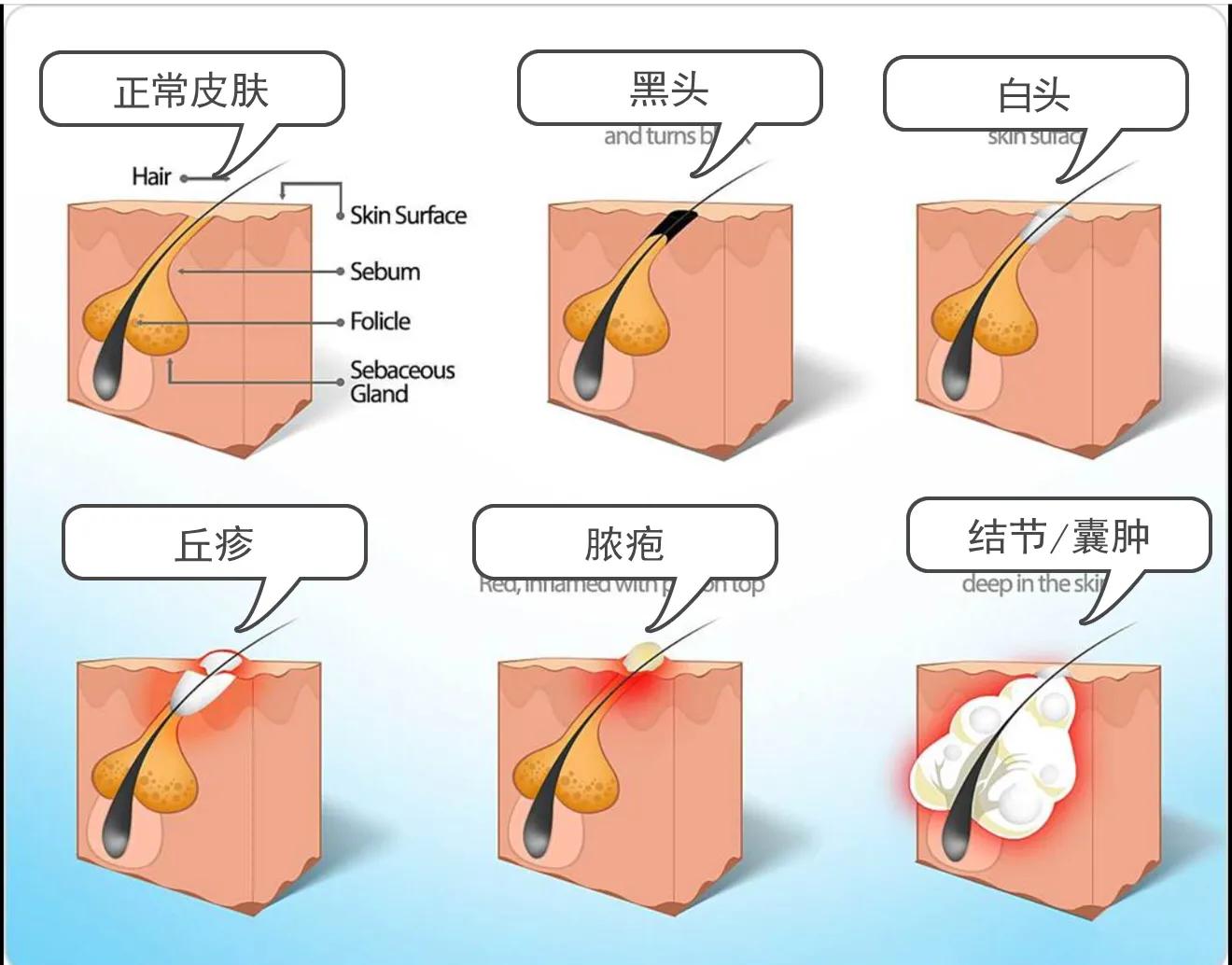 长疱疹的伤疤怎么治,长疮的疤痕怎么消除