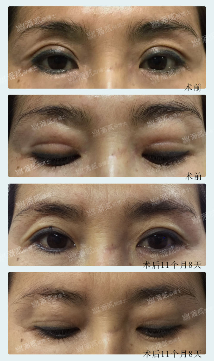 眼皮填充的脂肪凹凸不平怎么办,上眼皮凹陷填充脂肪有危险吗