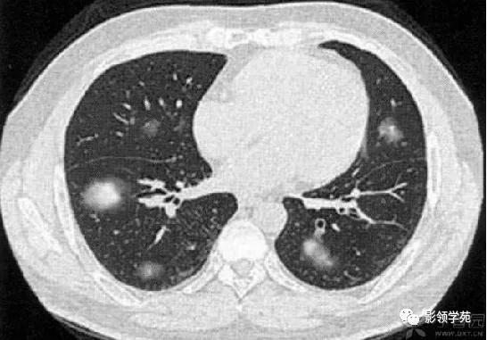 肺肉芽肿影像学表现ppt,肺韦格纳肉芽肿影像学表现