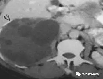 腹部平片能看到结石吗,腹部高密度结节影是什么