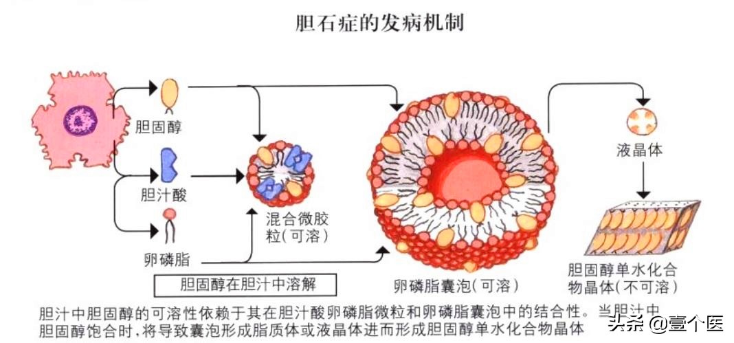 肝胆相照科普,胆囊肝胆相照
