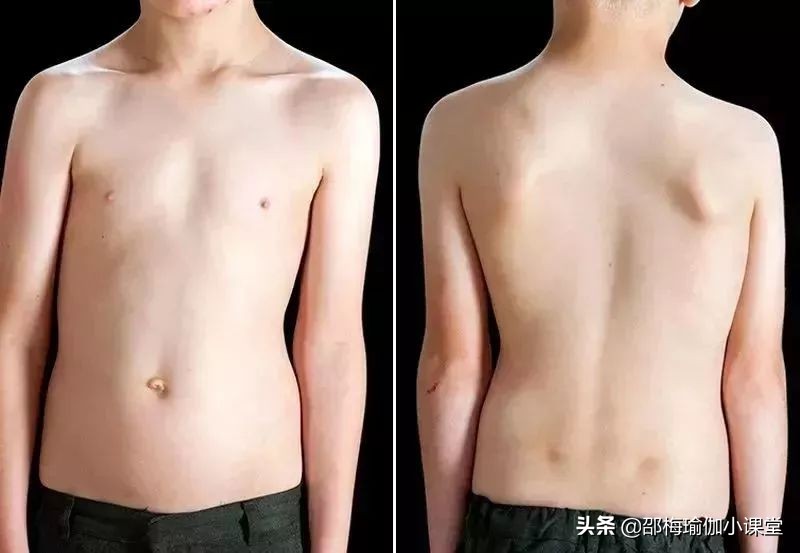 脊柱侧弯出现长短腿是多少度,脊柱侧弯长短腿怎么锻炼矫正视频