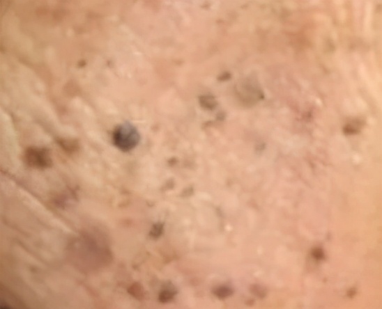 脸上长小颗粒的原因和解决方法,脸上长好多小颗粒如何解决