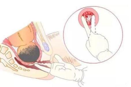 顺产和剖腹产哪个好一些,顺产好还是剖腹产好该怎么选择