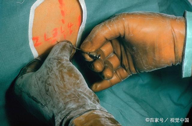 正在手术的病人突然醒了怎么办,手术中突然抽搐