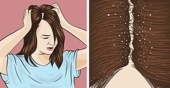 一到秋天头屑多是什么原因引起的,一到秋冬天头屑就多怎么回事