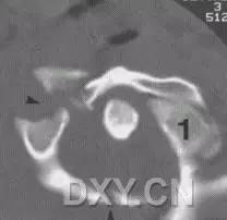 特殊骨折类型,特殊骨折体征