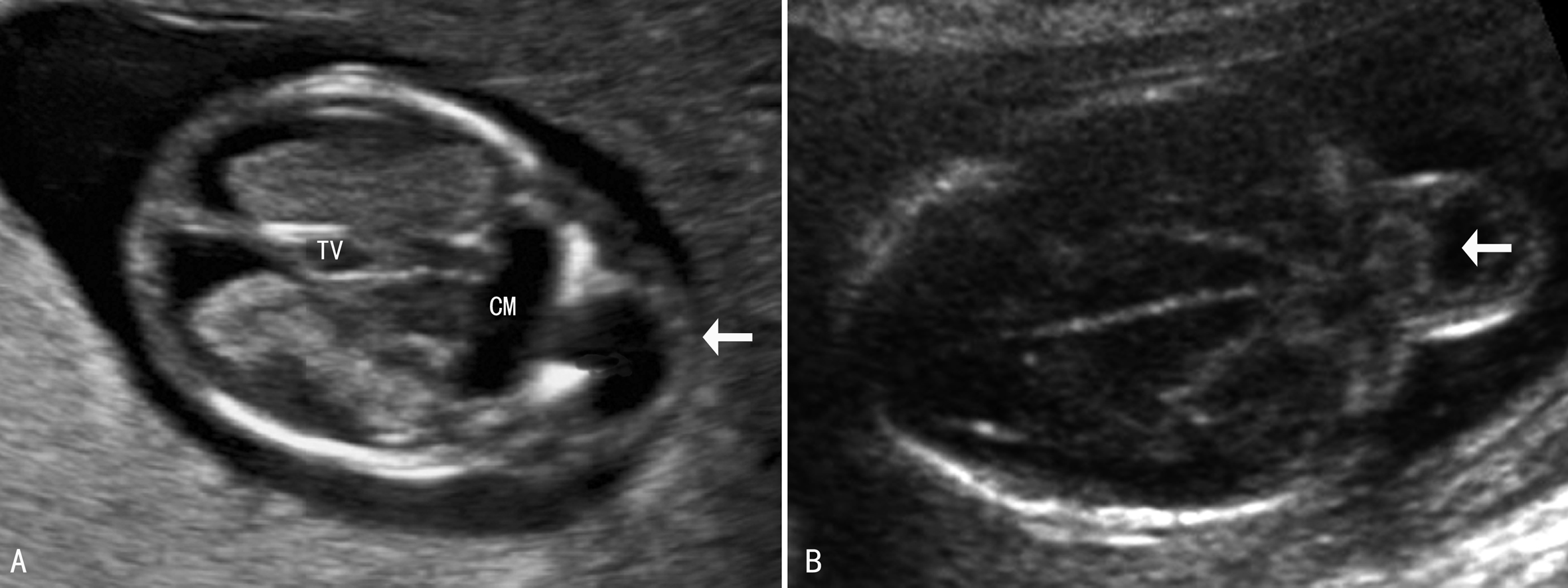 做普通彩超能不能看到胎儿侧脑室,超声胎儿针对性结构检查