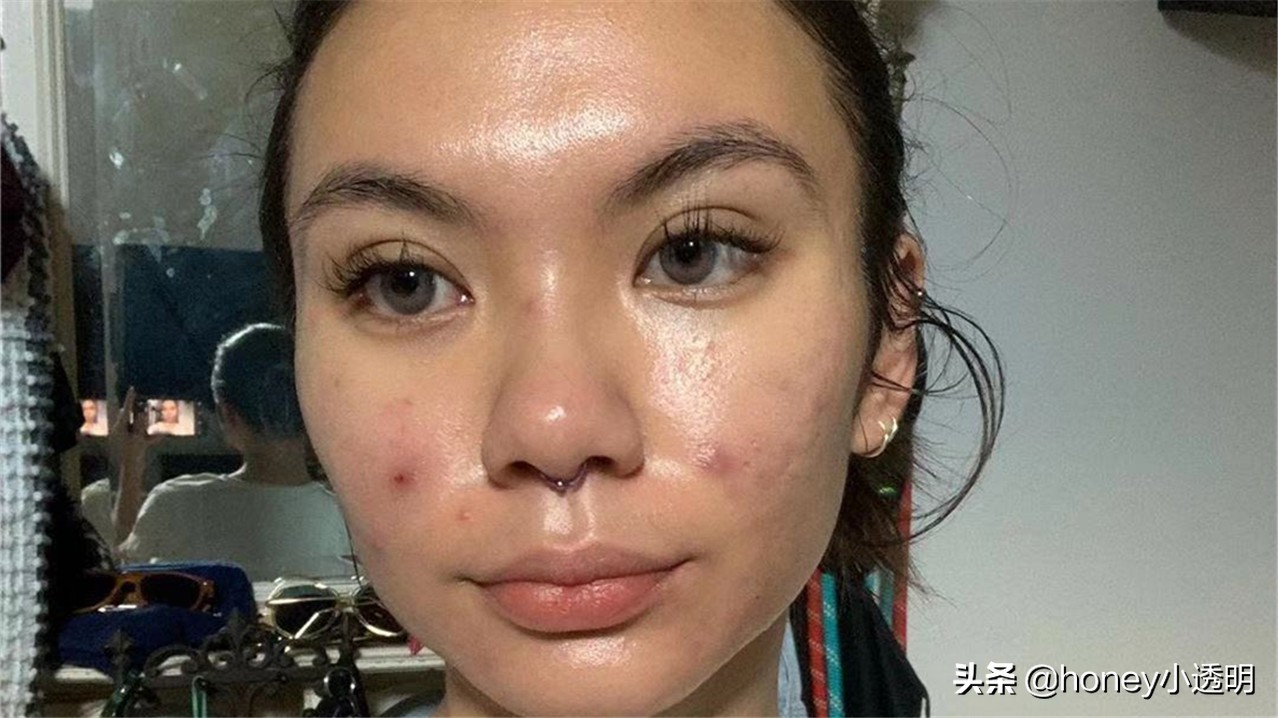 用粉刺针清理痘痘的步骤,用粉刺针清理粉刺