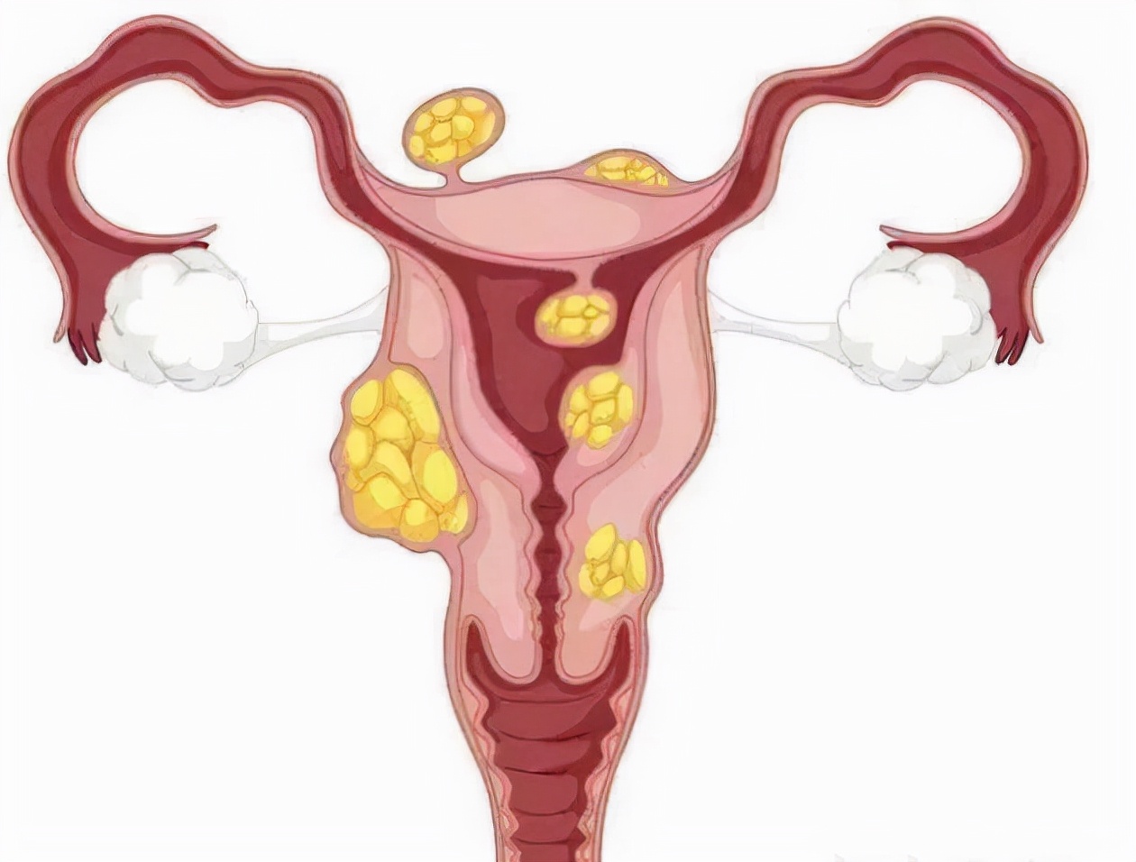北京大兴黄村子宫肌瘤手术,大兴县医院做子宫切除多少钱