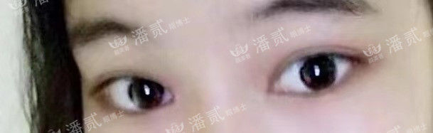女孩眼部整形失败,内眼角整形失败