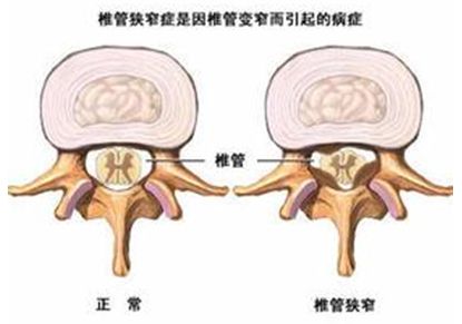 椎管狭窄引起的间歇性跛行怎么治,椎管狭窄间歇性跛行如何迅速恢复