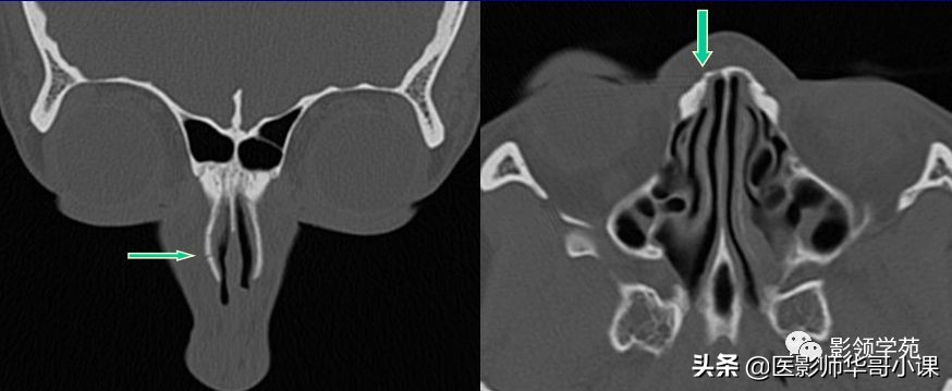 「鼻骨彩图」鼻骨CT解剖及骨折影像学诊断