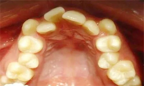 矫正牙齿你最关心的问题,矫正前需要问医生的问题