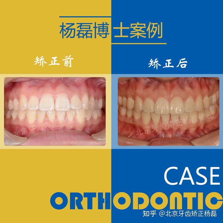 北京牙齿深覆合矫正推荐,重度拥挤牙齿矫正案例不拔牙