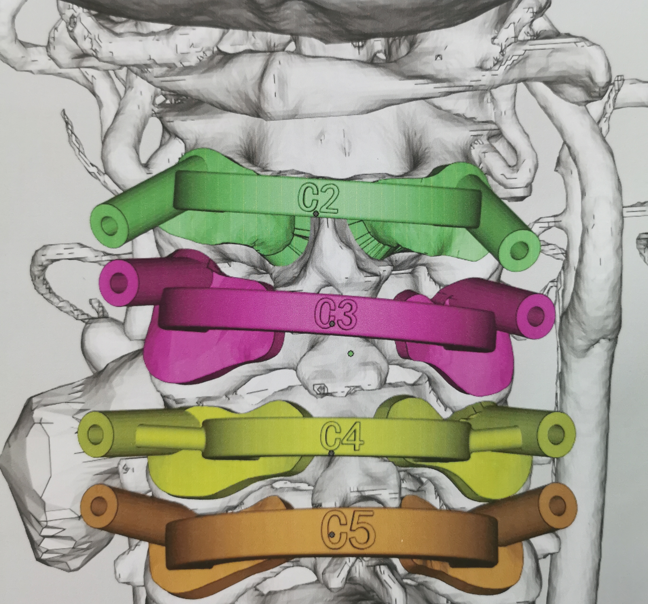 3d打印治疗脊柱肿瘤费用,颈椎3d打印手术要多少钱