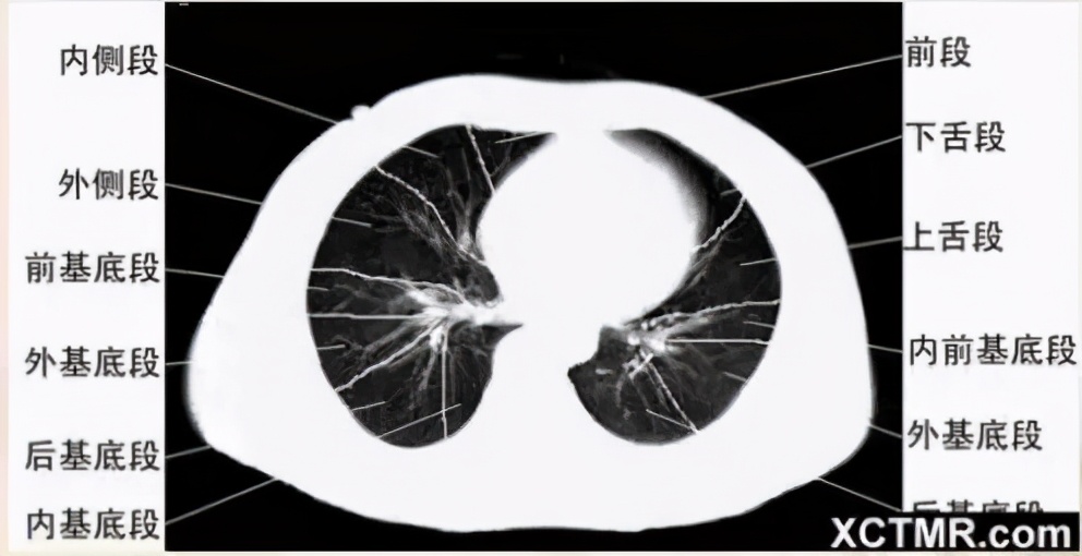 女性盆腔ct断层解剖结构图,女性盆腔脏器ct解剖