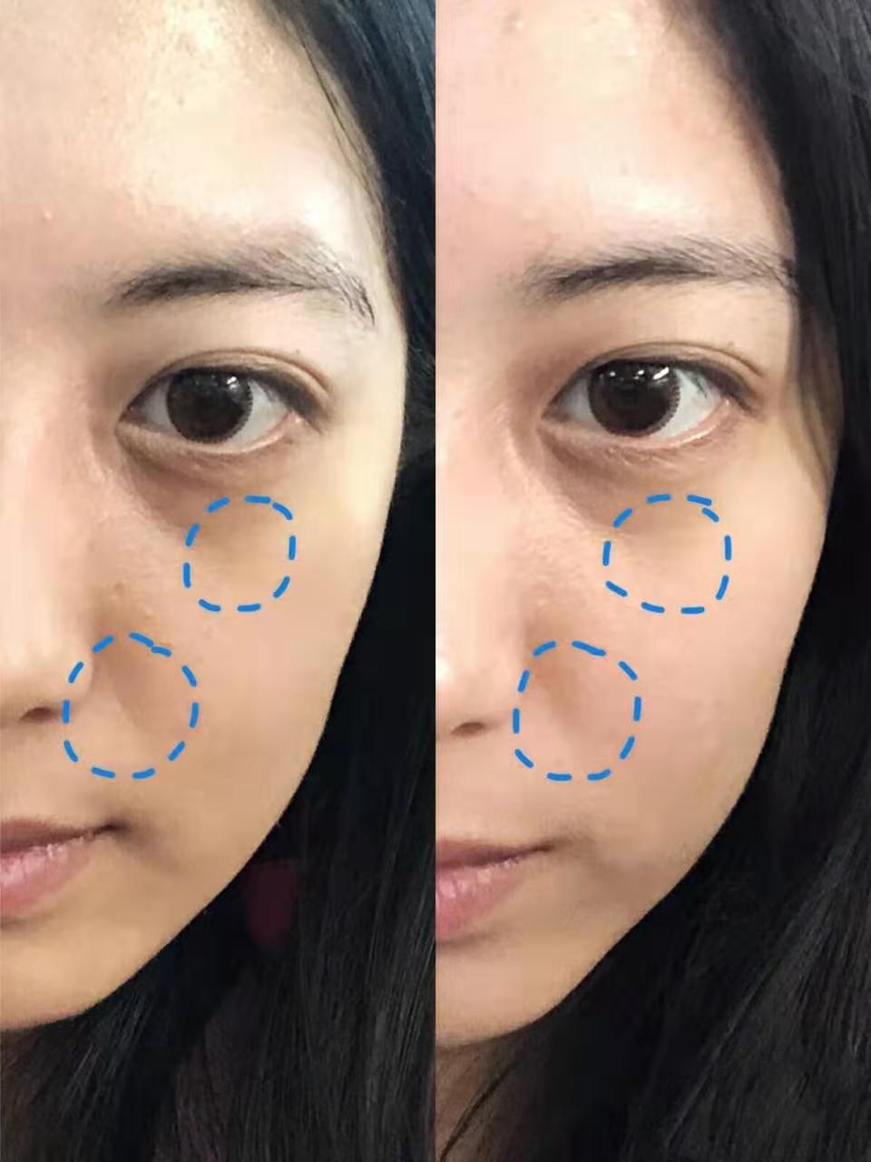 卸妆没卸干净闷痘怎么办,卸妆没干净长痘痘怎么办