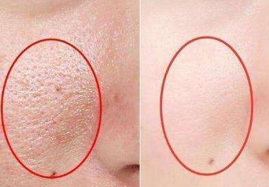 脸上毛孔粗大可以用什么护肤品,毛孔粗大的五个纯天然护理偏方