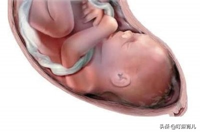 脐带脱垂对宝宝智商的影响,胎儿脐带扭转危害