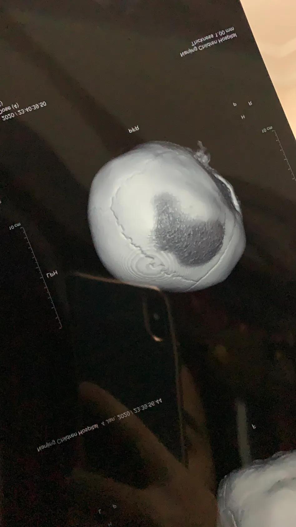 婴儿掉床怎样补救,婴儿掉床的正确处理方法