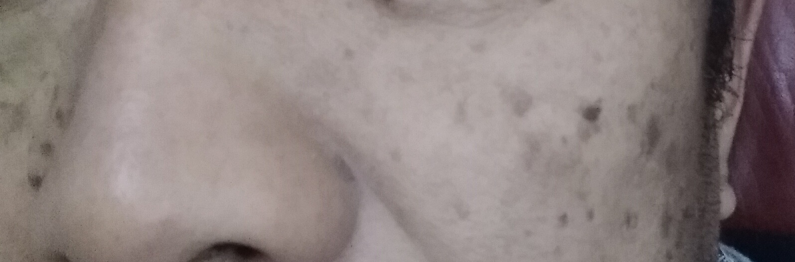 油溅到脸上有黑斑多久消失图片,脸上被太阳晒的黑斑怎么去除