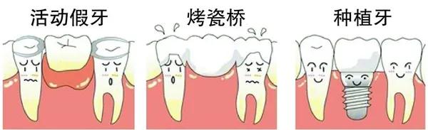 口腔种植专家为您解析,口腔种植牙科普