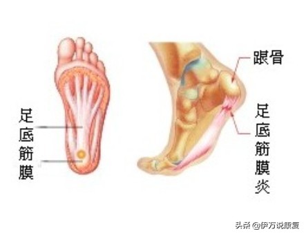 足底筋膜炎足跟痛四个动作,足跟痛足底筋膜炎如何治疗