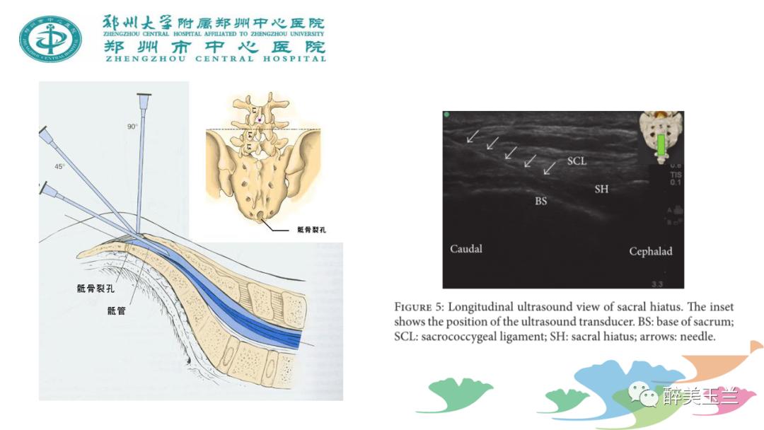 局麻药中毒的术前用药口诀,局麻药中毒临床表现及处理流程ppt