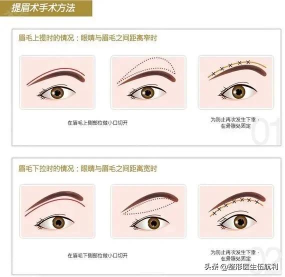 眼睛小应该做哪些眼综合手术,眼睛不对称怎么矫正医美