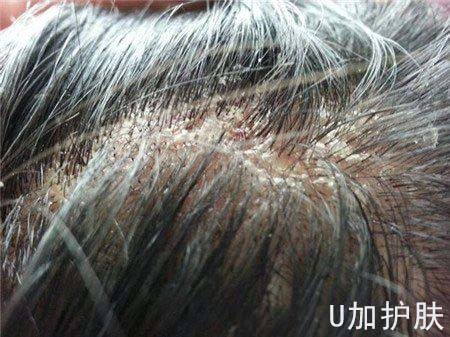 头皮干燥屑多是什么原因,洗头后头皮干燥头皮屑多掉屑很痒