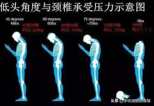一招解决颈后大包,纠正颈后大包练哪些肌肉