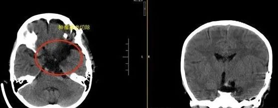 儿童脑肿瘤头痛和普通头痛的区别,小孩脑肿瘤晚期头痛怎么处理