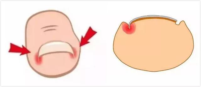 脚趾嵌甲怎么修剪,脚趾嵌甲严重长肉芽自己如何处理