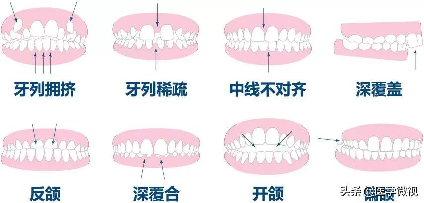 成年人的牙齿不齐可以矫正吗,牙齿不齐真的会影响命运
