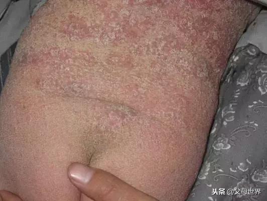 皮肤科医生儿童护肤品,皮肤科医生婴儿面霜