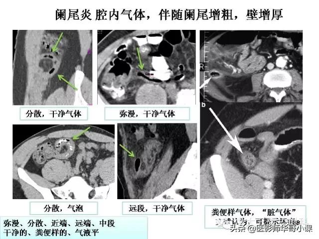 阑尾炎课件,阑尾炎的超声课件