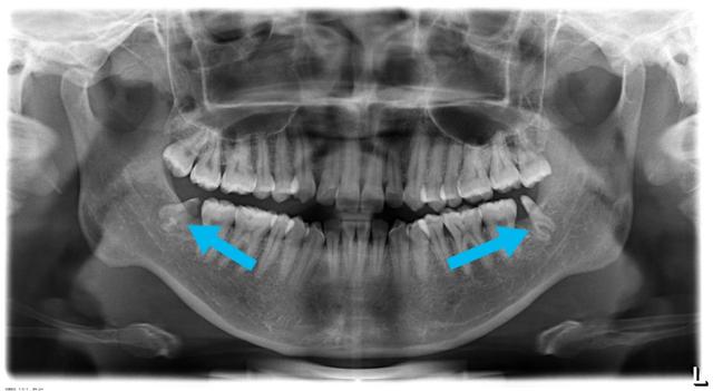 智齿老是发炎到底要不要拔掉,智齿总是发炎为什么牙医建议不拔