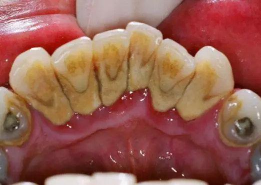 牙齿多久不刷会形成牙垢,牙齿背面没刷可以吗