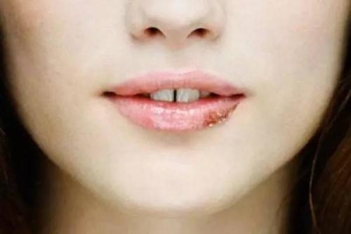 嘴角长泡是上火还是口腔溃疡,口腔内嘴唇起泡是什么原因