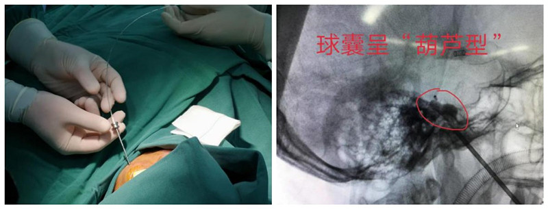 顽固的三叉神经痛一针搞定,一针治疗一绝