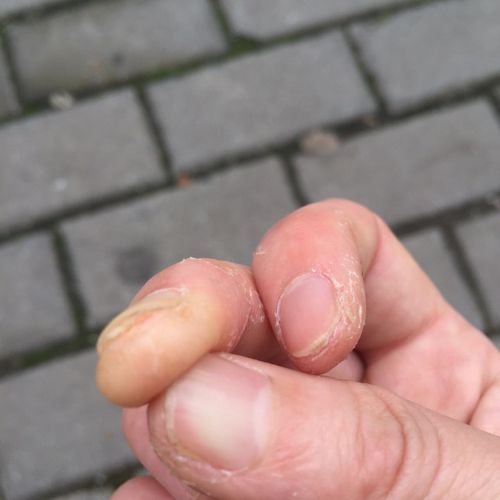每年春季手指起泡脱皮,春季手指脱皮是怎么回事