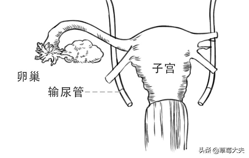 「人气案例」宫颈癌手术就得终生挂尿袋生活？草莓医院专家SayNo