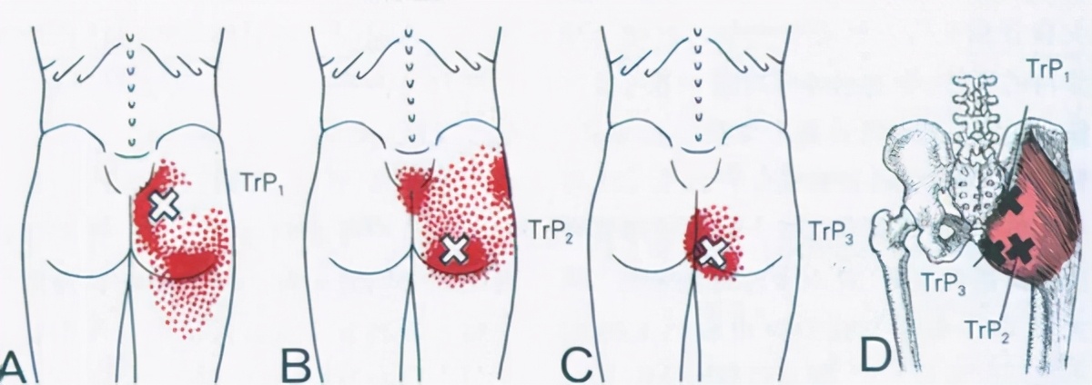 久坐腰骶麻木疼活动后减轻,久坐导致腰骶部疼吃什么药
