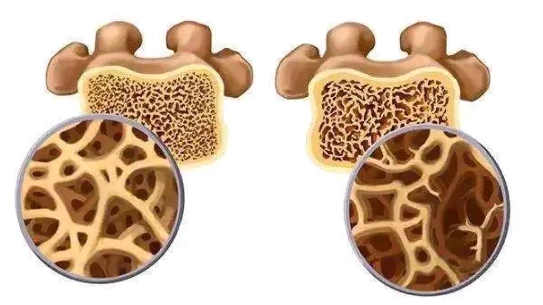 绝经情绪低落要怎么调理,女人绝经骨质疏松腰痛到底有多疼