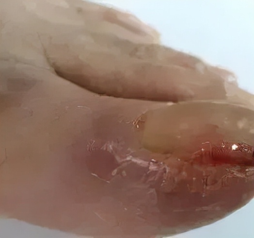 靶向药皮肤副作用怎么缓解,靶向药物副作用引起皮肤溃烂图片