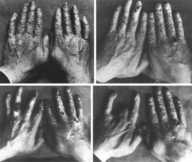 用X光脱毛、试鞋、选美，那些玩X光的勇士最后都怎样了？