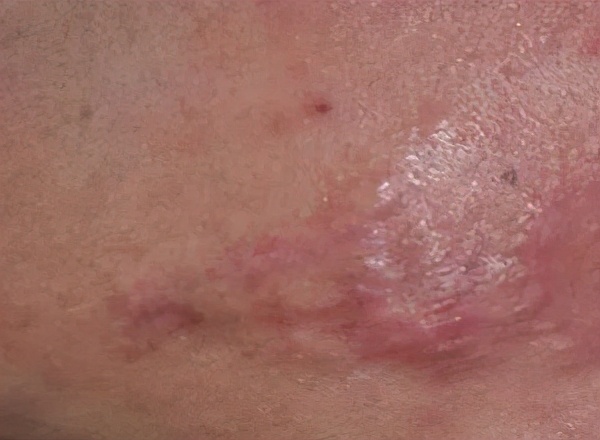 被火烫伤疤痕修复最好的方法,烧烫伤疤痕治疗的方法都有哪些