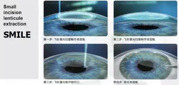 目前矫正近视手术全飞秒和半飞秒,近视眼手术全飞秒半飞秒怎么选择